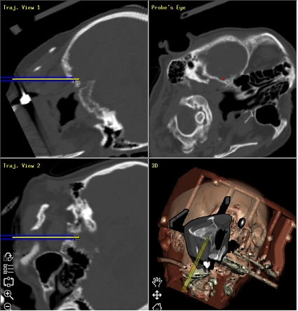 Die Öbungen vom Stab bei der Osteochondrose der Wirbelsäule